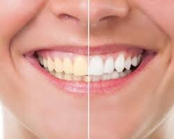Teeth Whitening in Noida at Floss Dental Clinic