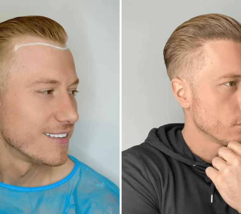 What Is The Best Season To Get Your Hair Transplant Done?