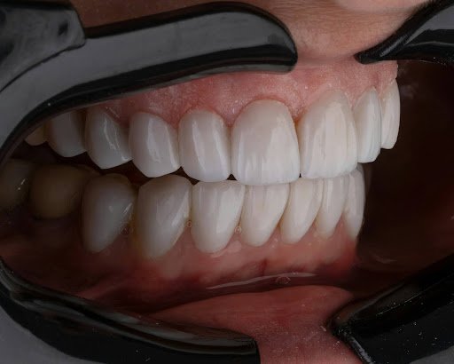 What To Expect From An Immediate Denture Procedure